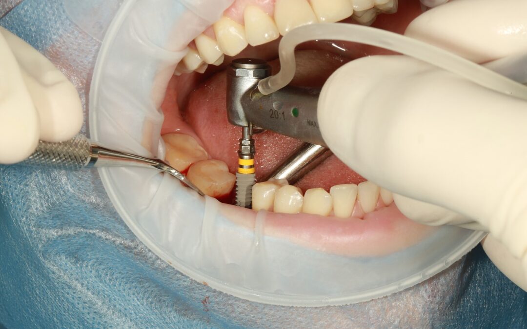 Anatomie d'un implant dentaire